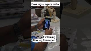 explaining how to correct Bow leg bowlegs bowedlegs legs [upl. by Lewap]