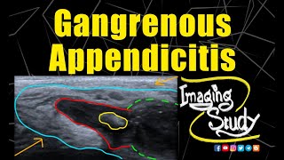 Gangrenous Appendicitis  Ultrasound  Case 211 [upl. by Muslim200]