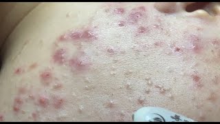 How to treat acne during pregnancy  No P4 HoangMySpa130 [upl. by Yerhcaz]