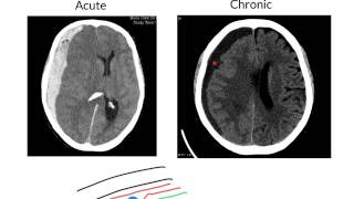 Subdural haemorrhage [upl. by Naryt]