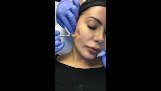 Bellafill Injections for Acne Scarring with Dr Jason Emer MD  Live  Part 1 of 3 [upl. by Pine871]