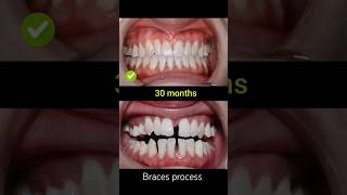 braces evolution braces process braces transformation braces orthodontist dentist shorts [upl. by Tobi]