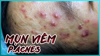 Big Cystic Acne Blackheads Extraction Blackheads amp Milia Whiteheads Removal Pimple Popping [upl. by Ailey]