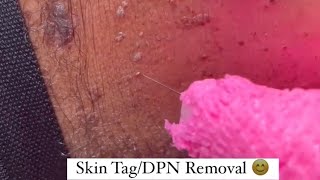 Skin Tag Removal or Dermatosis Papulosa Nigra DPN Removal [upl. by Nihs365]