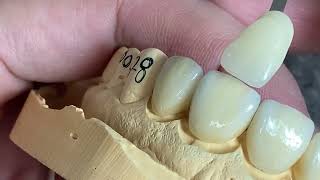 How to Make Full Shape Emax Veneers Look More Alive [upl. by Elsinore]