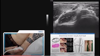 Distal biceps brachii tendon anterior and medial approach  2 min series MSKUS [upl. by Fitting80]