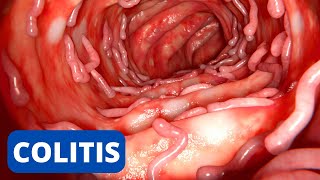 La COLITIS explicada síntomas tipos consecuencias tratamiento prevención [upl. by Nonnahc237]