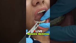 LIVE Braces Removal Dr Srishti Bhatia braces teeth smile [upl. by Francine]