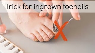 How to Fix Ingrown Toenails Easily [upl. by Eilata482]