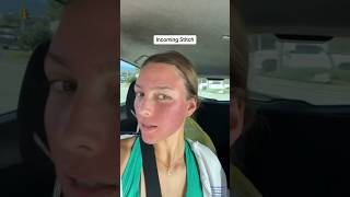 Microneedling on Acne Scars shorts [upl. by Leafar]