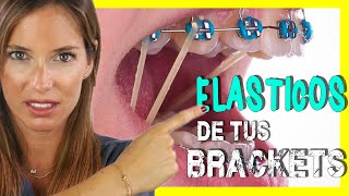 🖍📒ELASTICOS INTERMAXILARES para asentar MORDIDA  Para que sirven las GOMAS de los BRACKETS [upl. by Alejandrina]