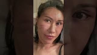 PostOp 1 year  Freshia’s Healing and Rejuvenation Journey facelift [upl. by Grimaldi280]