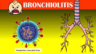 Understanding The Basics On Bronchiolitis  Causes Signs amp Symptoms Diagnosis Treatment [upl. by Kjersti]