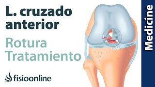 Rotura de ligamento cruzado anterior  Diagnóstico tratamiento de fisioterapia médico y quirúrgico [upl. by Carie]