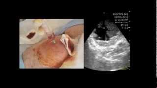 VSCAN Abscess in the femoral region Pocket Ultrasoundguided puncture absceso crural [upl. by Hach]