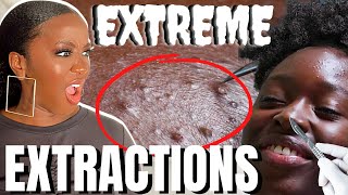 Reacting to EXTREME Blackhead Extractions on Black Skin [upl. by Happy]