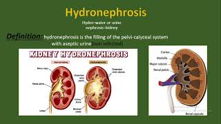 Hydronephrosis Definition causes and etiology pathology types diagnosis treatment [upl. by Netnerb]