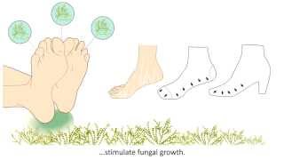 Onychomycosis  What is it and how is it treated [upl. by Nirehtak]