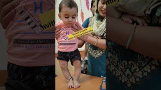 Leg deformity in babiesshorts youtubeshorts baby [upl. by Airenahs]