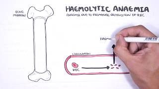 Haemolytic Anaemia  classification intravascular extravascular pathophysiology investigations [upl. by Yltneb]