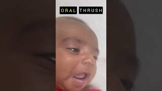 Treatment of Oral Thrush oralthrush treatment [upl. by Ande]