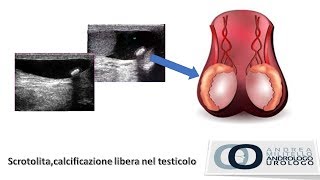 Lo scrotolita una calcificazione del testicolo Andrologo Dr Andrea Militello [upl. by Doralyn]