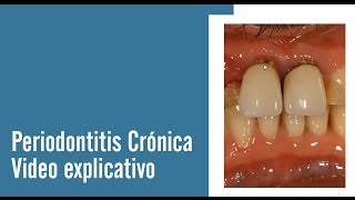 Periodontitis Crónica  Juan Salgado  Enfermedades Periodontales  Video explicativo [upl. by Zeni]