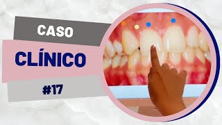 Caso clínico agenesia de incisivo lateral  Indiara Dentista 17 [upl. by Mathilda]