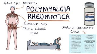 Polymyalgia Rheumatica Visual Explanation for Students [upl. by Einahpts]