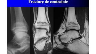 Imagerie médicale en pathologie sportive de l’enfant et de l’adolescent [upl. by Aleydis]