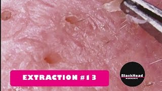 Whitehead and BlackHead RemovalExtraction 13 [upl. by Nnaul874]