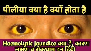 Jaundice In Hindi पीलिया  Hemolytic jaundice  high bilirubin  high Unconjugated level  piliya [upl. by Elle]