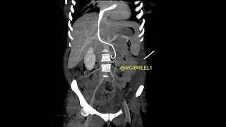 Intracardiac migration of ureteral doubleJ stent till the PV level [upl. by Asiulana]