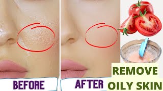 How to Get rid of Oily Skin Permanently  Home Remedies for Oily Skin amp Pimples  Get Glowing Skin [upl. by Yanaton127]