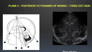 TMT Neurosono by Dr Mrudula Bapat  Basic Anatomy amp Scanning Technique [upl. by Lemrahc]