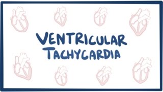 Ventricular tachycardia VT  causes symptoms diagnosis treatment amp pathology [upl. by Nedyarb]