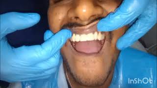 Crown cutting of Front Teeth And Cap Fixing Final look [upl. by Mumford]