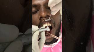 உடைந்த பல் சரி செய்தல்  Fixing broken teeth Dr Dinesh Kowsky [upl. by Atikam943]