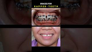 BRACES FOR GAPPED TEETH 32 MONTHS DURATION braces orthodontist dentist [upl. by Ailimac233]