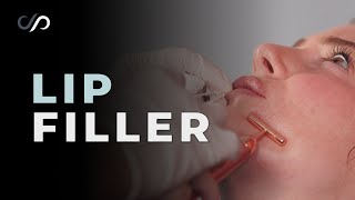 FirstTime Lip Filler Experience  Upper amp Lower Lip Enhancement [upl. by Ynatterb]