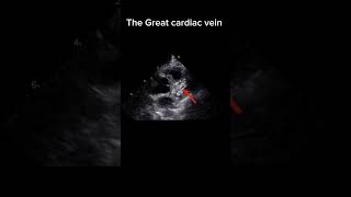 The Great Cardiac vein in echocardiography echocardiography heartartery echocardiographer [upl. by Elleuqram]