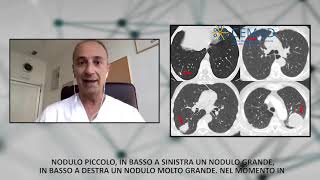 Approccio Diagnostico ai Noduli Polmonari [upl. by Barclay110]