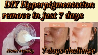 remove permanently hyperpigmentatoin with home remedy  7 days challenge  skin care routine [upl. by Nicholle]