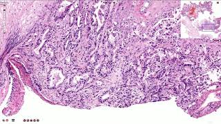 Adenocarcinoma of the Esophagus  Histopathology [upl. by Ulland]