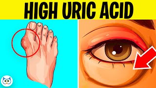 7 Symptoms of High Uric Acid Levels In The Body  Gout Symptoms [upl. by Patten]