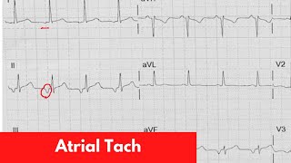 Atrial Tach  For DO MD NP PA Part 4 [upl. by Nancee]