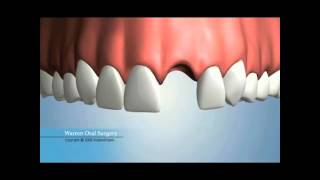 Single Missing Tooth Replacement Options [upl. by Onaimad871]