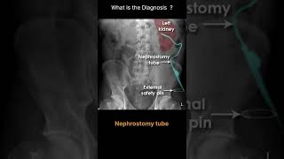 Nephrostomy tube Abdominal Xray Artifacts  Renal and ureteric stents 100 radiologychannel007 [upl. by Enneibaf]