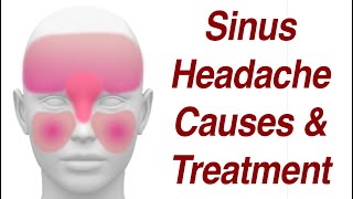 Sinus Headaches Causes amp Treatment [upl. by Ocinemod]