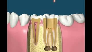 Root canal treatment animation [upl. by Yrro]